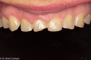 Veneers