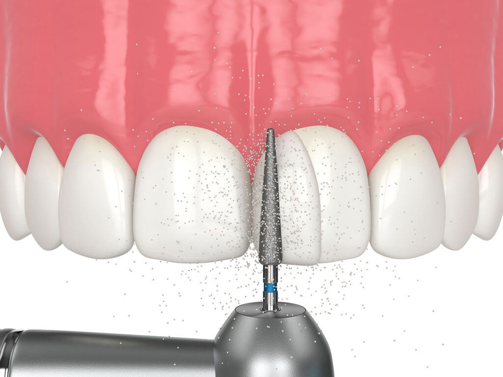 Dental Bonding Shaping Contouring Your Smile