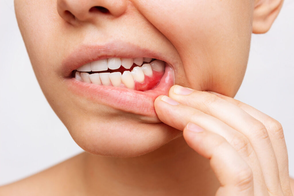 Gum Disease Prevention Warning Signs And Periodontal Treatments In Rogers