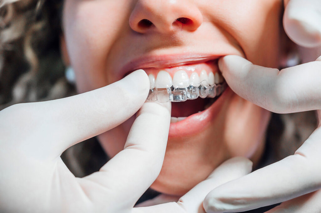 Invisalign and Clear Aligners: Straightening Teeth Without Braces